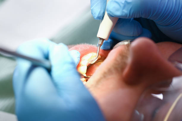 Best Emergency Tooth Extraction in Beechwood, MI